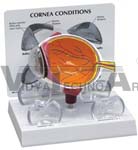 Cornea Eye Model Cross-Section w/ Patient Education Card